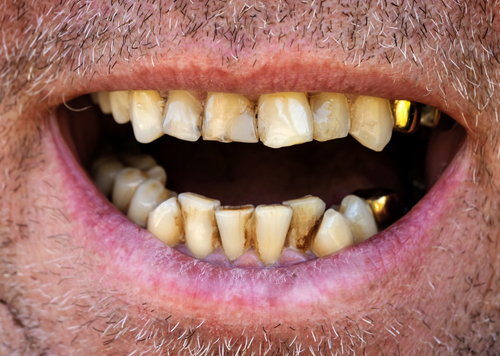 Peut-on poser des facettes sur des dents abîmées ou dévitalisées ?