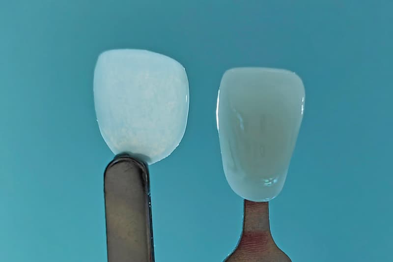 Les Facettes Dentaires Ultra-Fines : La Révolution du Sourire Naturel