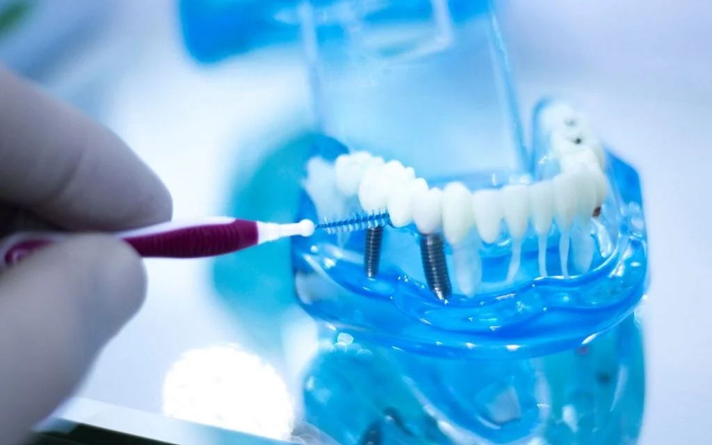 Hygiène autour des implants : prévenir la péri-implantite