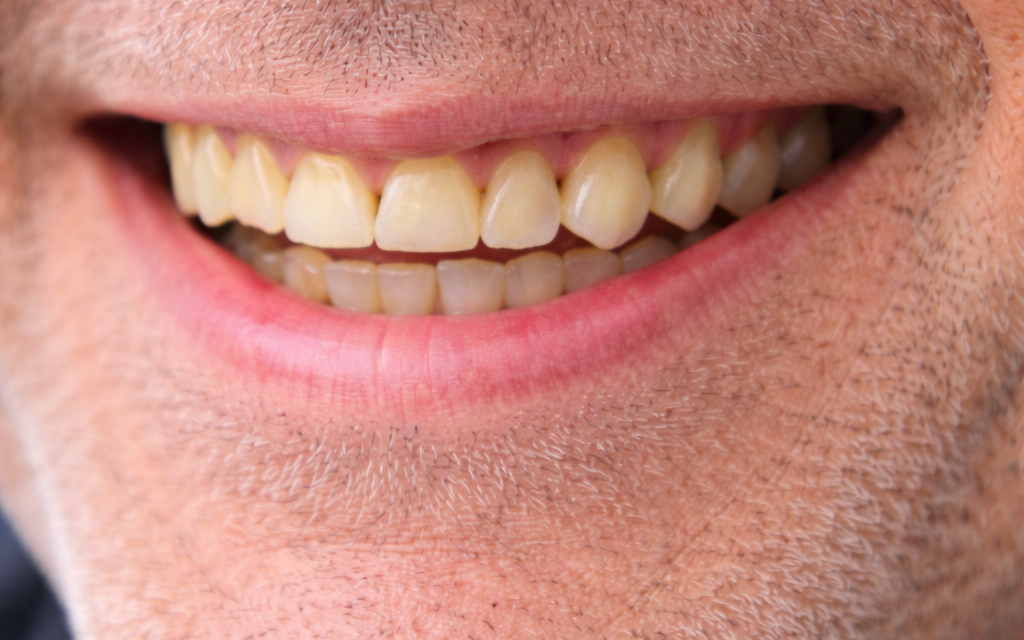 Dents trop courtes ou usées : solutions esthétiques modernes